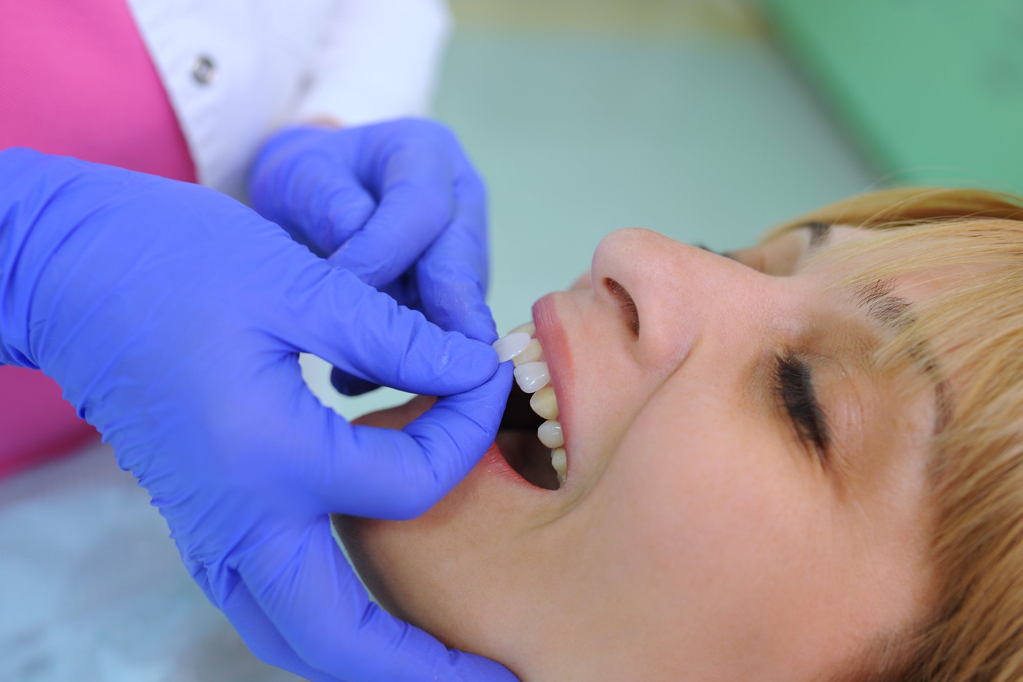 How Can I Fix Stained Teeth That Won't Whiten?